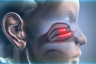 polyps in nose in pattern