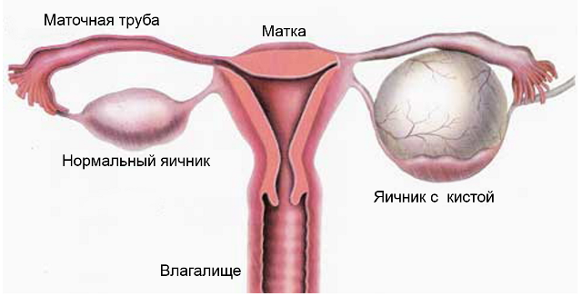 What if I have a hormonal ovarian cyst?