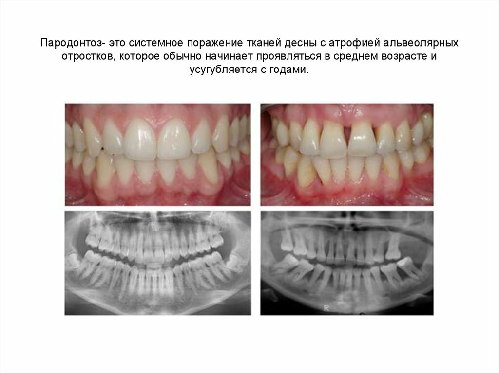 Diagnosis dan pengobatan pyorrhea alveolar