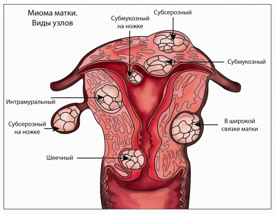 Myoma van de baarmoeder tijdens de zwangerschap: is het gevaarlijk, wat is bedreigend, wat zijn de gevolgen voor het kind? Kan myoma van de baarmoeder worden verward met zwangerschap? Kunnen baarmoederfibroids bedekken, pijn doen of oplossen tijdens de zwangerschap?