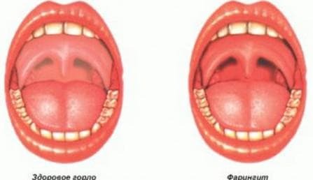 Of faryngitis wordt overgedragen, is het besmettelijk of niet?