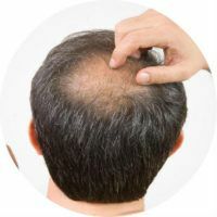 כיצד לטפל alopecia ב גברים ונשים