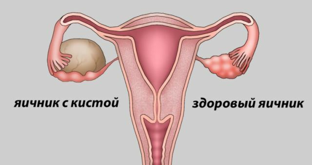 The hemorrhagic cyst of the ovary is revealed: how dangerous is it, how it is treated, can it become pregnant?