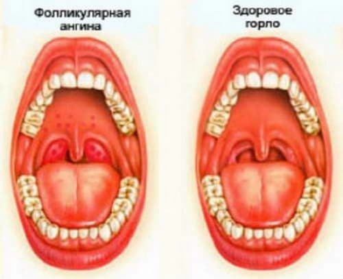 Akūts folikulārs tonsilīts