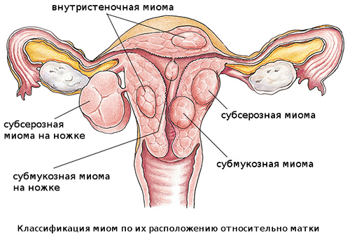 Objawy mięśniaków macicy z menopauzą