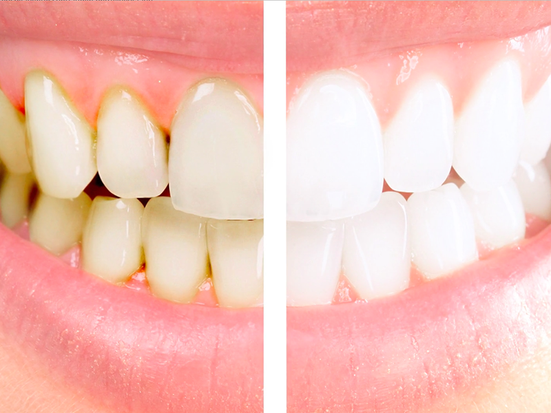 Hoe je tanden witter te maken thuis? White Light Teeth Whitener. Prijs, handleiding en opmerkingen over White Light. Waar kunt u een set wit licht kopen of bestellen?