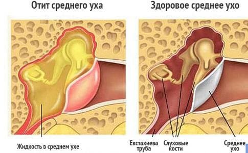 Ear inflammation treatment at home