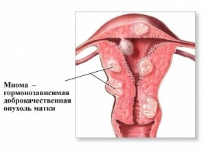 Melakukan olahraga dengan myoma uterus