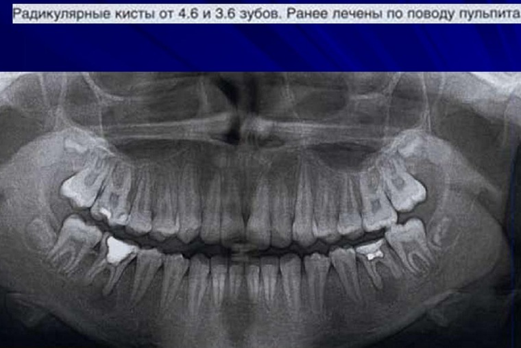 Cisto radicular: características da clínica e métodos de remoção da educação