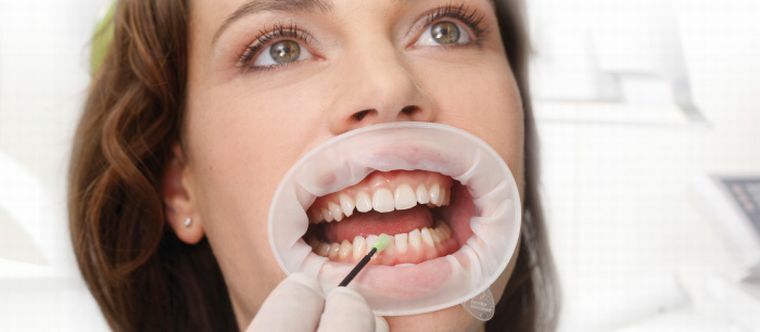 Objetivos e características da aplicação do retractor dental oral Optragate