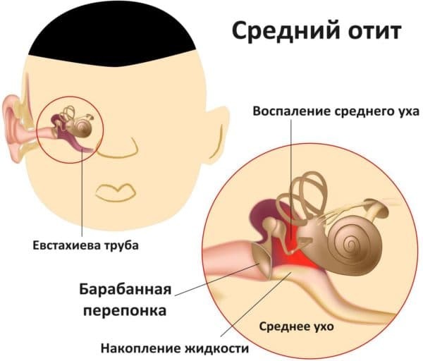 Diagnóza zápalu stredného ucha v prípade dieťaťa