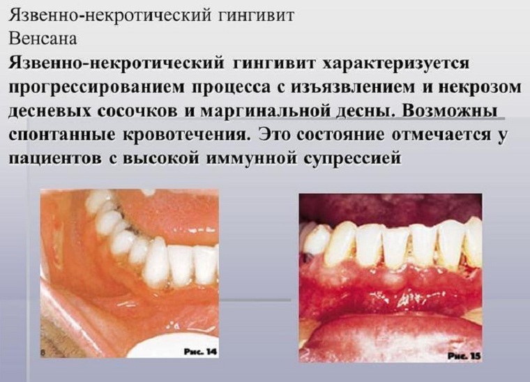 Wrzodziejące martwicze zapalenie dziąseł: objawy, rozpoznanie, leczenie