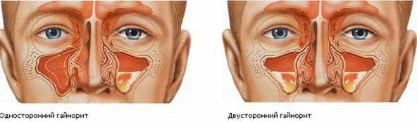 Apa itu sinusitis yang berbahaya?