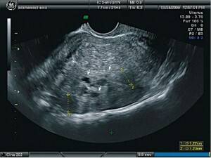 Menstruação com adenomiosis