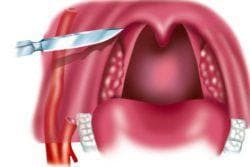 Hvordan gjenkjenne en paratonsillar abscess: de viktigste symptomene