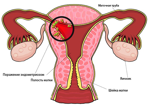 Adenomyosis and endometriosis: how to distinguish these diseases?