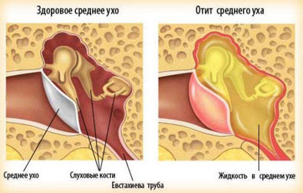 otitis media of the middle ear