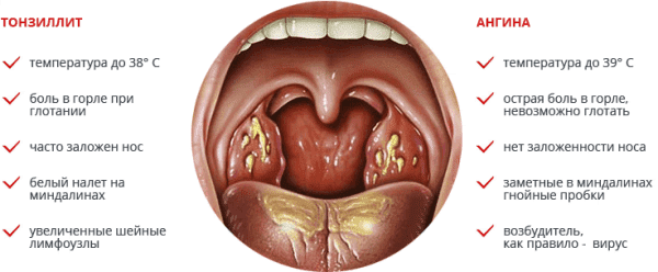 a diferença entre angina e amigdalite