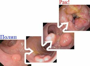 Pólipos do cólon - formações inofensivas ou um perigo grave?