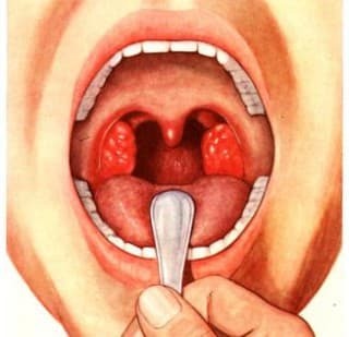 chronic bacterial tonsillitis