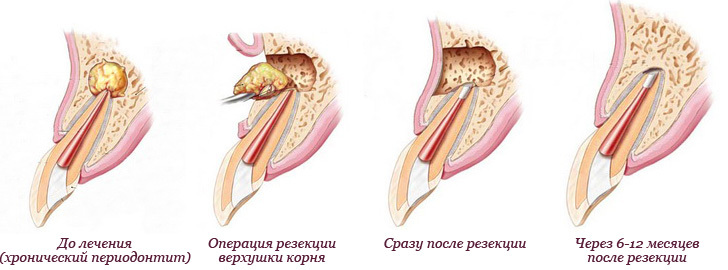 Granuloma op de wortel van de tand: symptomen en behandeling