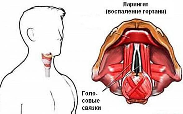 acute laryngitis