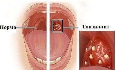 chronische tonsillitis symptomen en behandeling bij kinderen