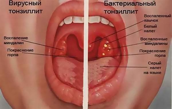 tonsillitis bij een kind