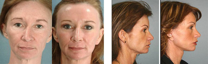 Photorejuvenation van gezichtshuid. Foto's van vrouwen voor en na