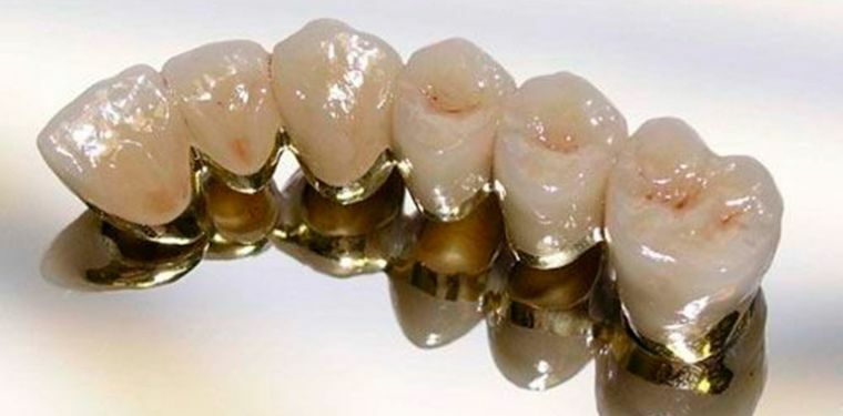 Posso fazer ressonância magnética com implantes dentários, coroas, aparelhos?