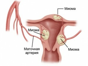 The use of folic acid in uterine myomas